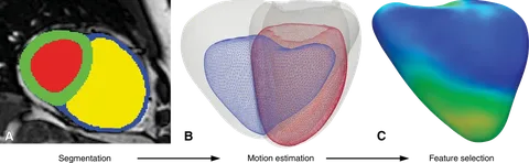 Machine learning pipeline for cardiac motion analysis: A) MRI segmentation of heart chambers, B) 3D motion estimation of right ventricle between systole and diastole, C) feature selection showing wall motion patterns used for outcome prediction